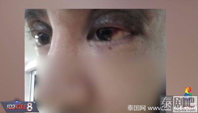 泰男子割双眼皮4次都失败求助赔偿